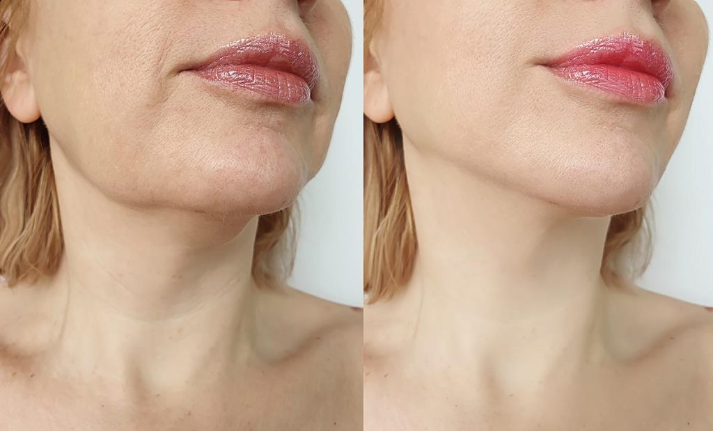 Jaw & Chin Fillers – Hannah Aesthetic Clinic